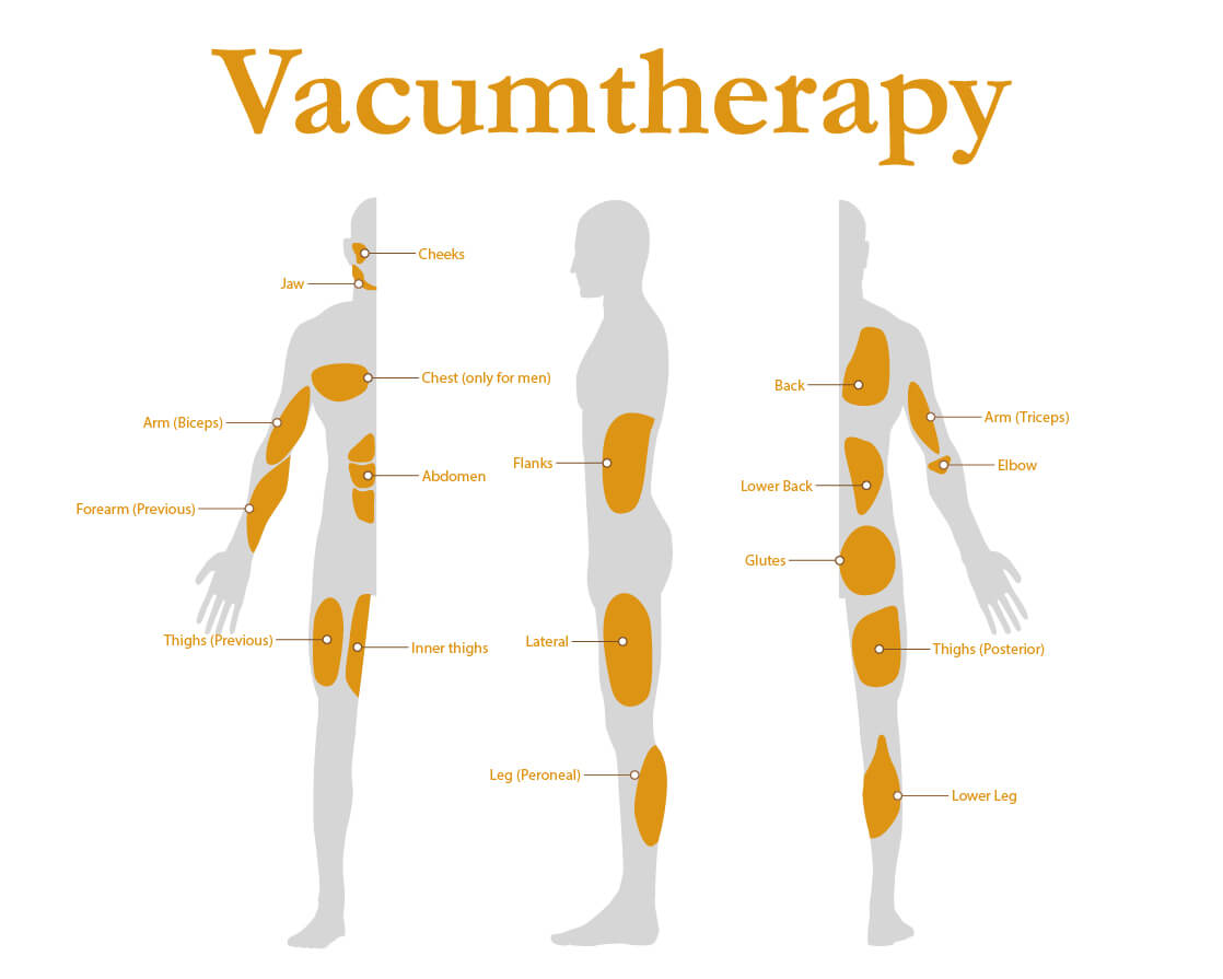 Diagrama Vacumterapia