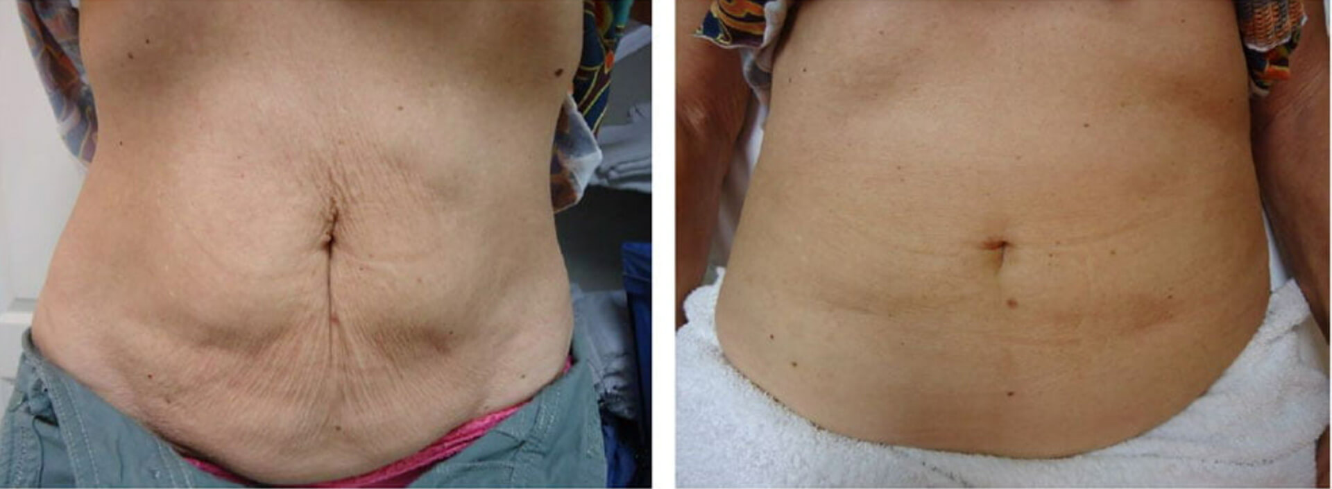 Before and After VelaShape
